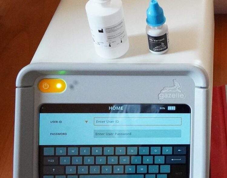Siaya Strengthens Early Screening for Sickle Cell Disease with New Electrophoresis Machine